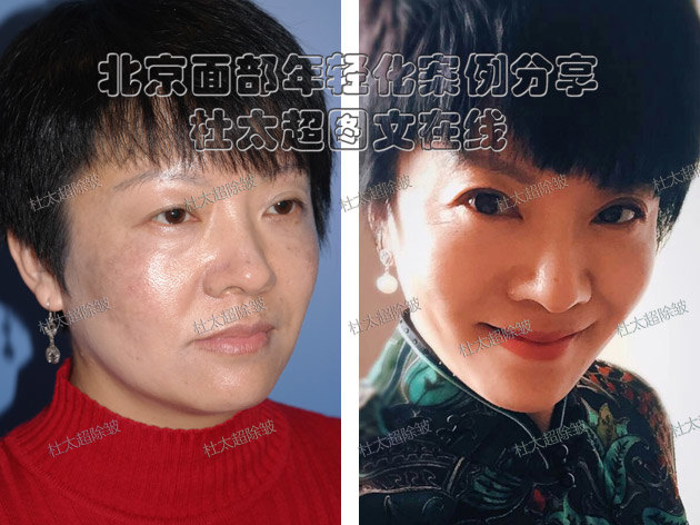 中下面部松弛--筋膜悬吊术是什么?