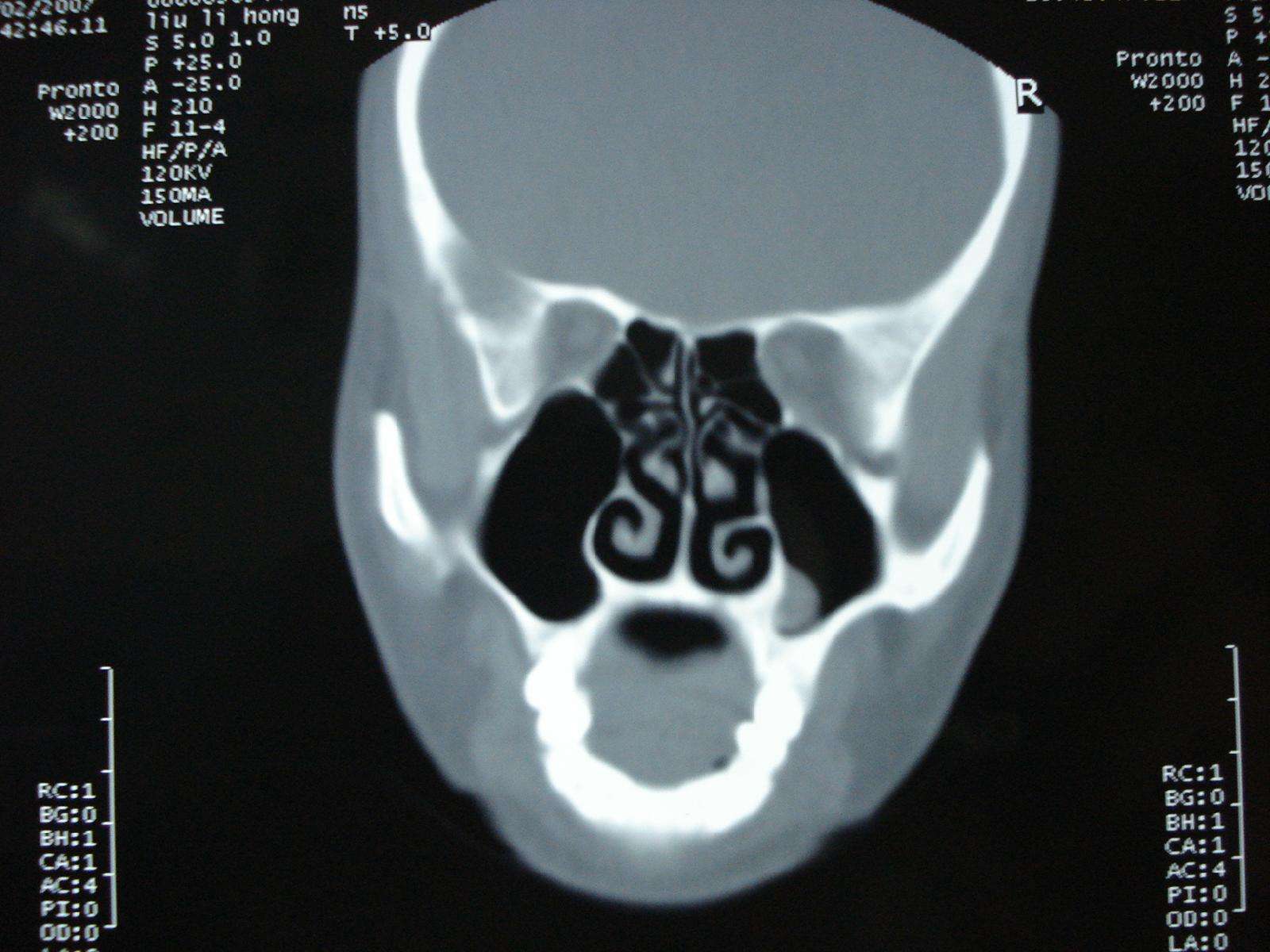 上颌窦囊肿位置图图片
