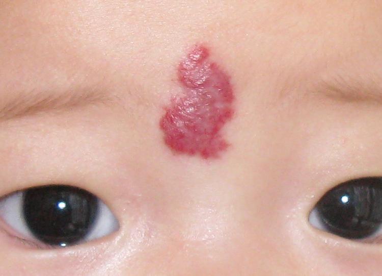典型婴幼儿血管瘤图片与血管痣鉴别 