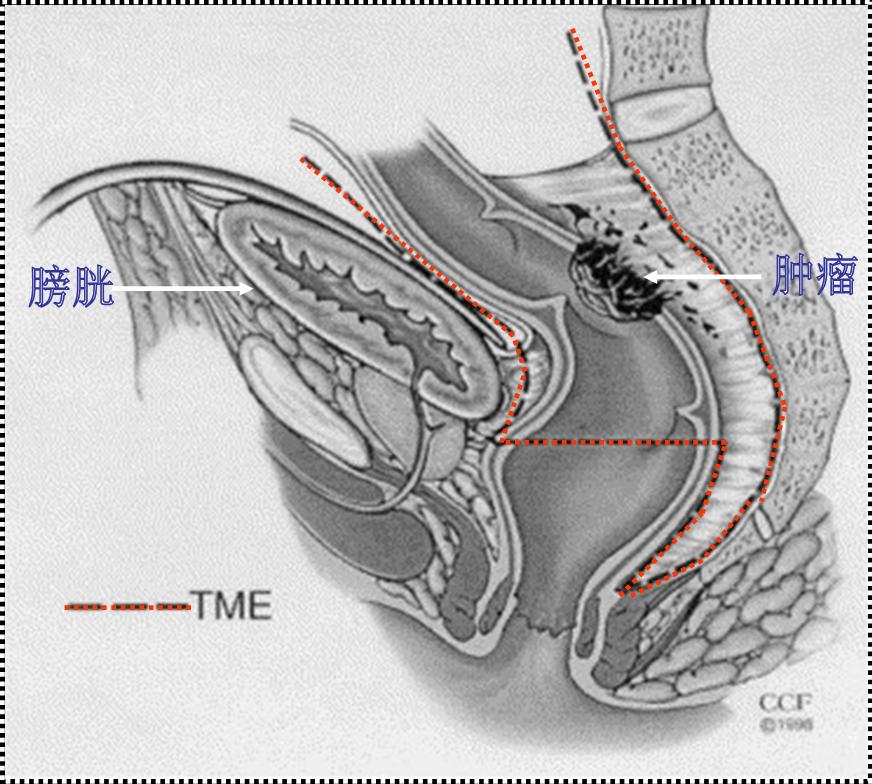 直肠癌手术治疗新观念——全直肠系膜切除技术