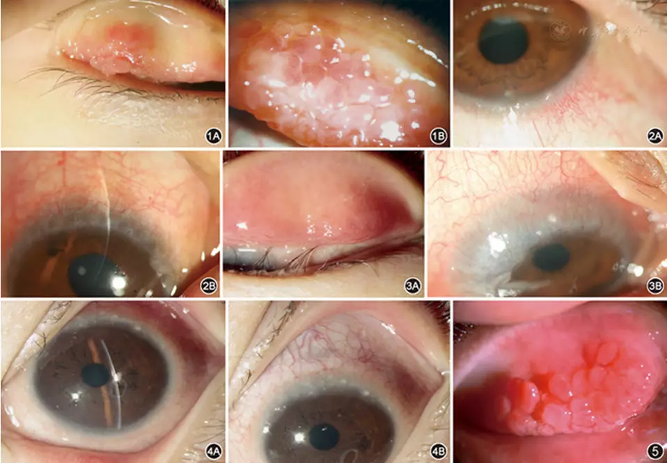 我国过敏性结膜炎诊断和治疗专家共识(2018年) - 好大夫在线