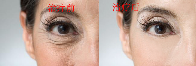 面部脂肪填充(脂肪干细胞胶注射)--面部年轻化