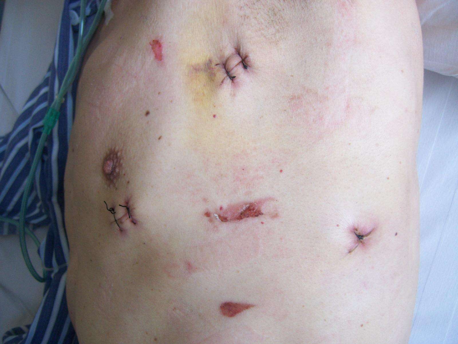 经电视胸腔镜行胸腺瘤切除术 - 好大夫在线