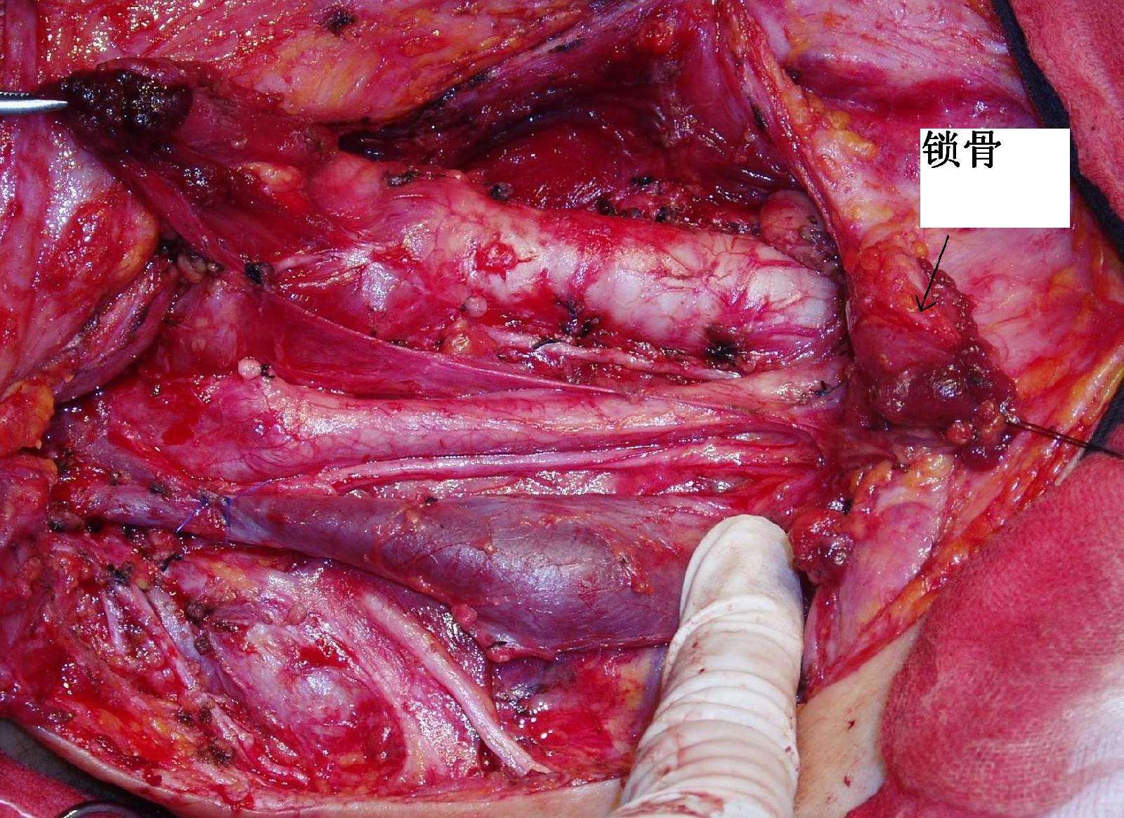 晚期甲状腺癌颈淋巴结清扫术切口的改进--颈锁骨下的大弧形切口 - 好