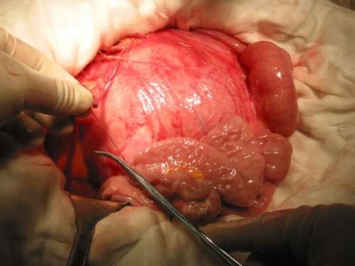 我切除的1例腹膜后硬纤维瘤第3次复发照片 - 好大夫在线