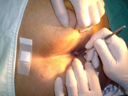 手术结束,术后肛门外观行内痔残端硬化剂注射切除痔核及肛乳头瘤切除