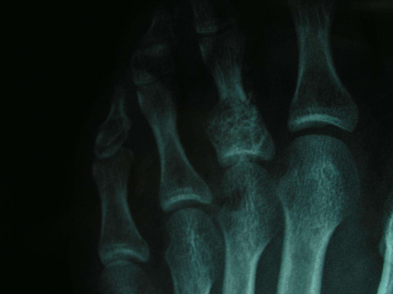 内生软骨瘤(enchondroma) - 好大夫在线