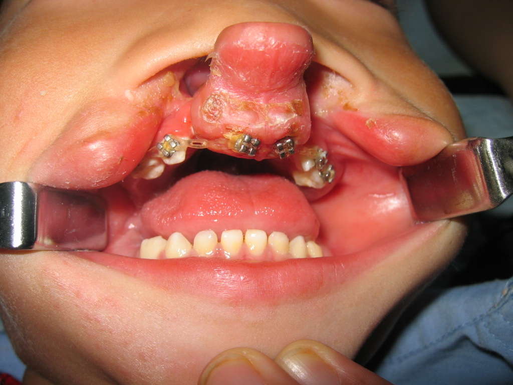 若有前颌突前突的,就像这个孩子:然而,如果是双侧唇裂就不是简单的先