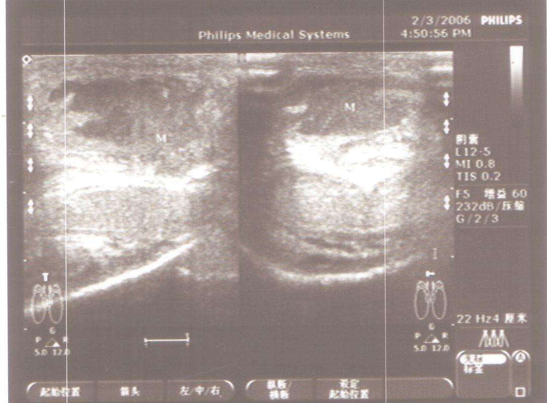 超聲診斷陰莖海綿體斷裂1例