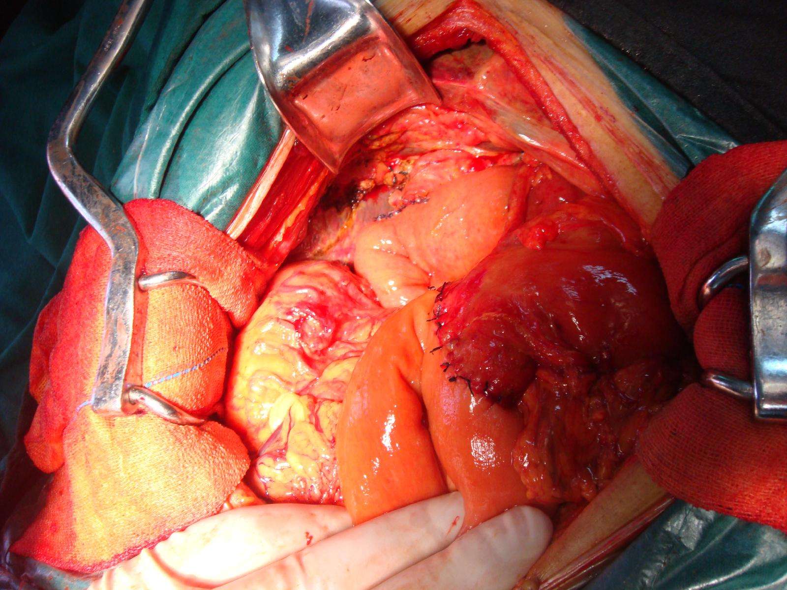 保留幽门的胰十二指肠切除术 - 好大夫在线