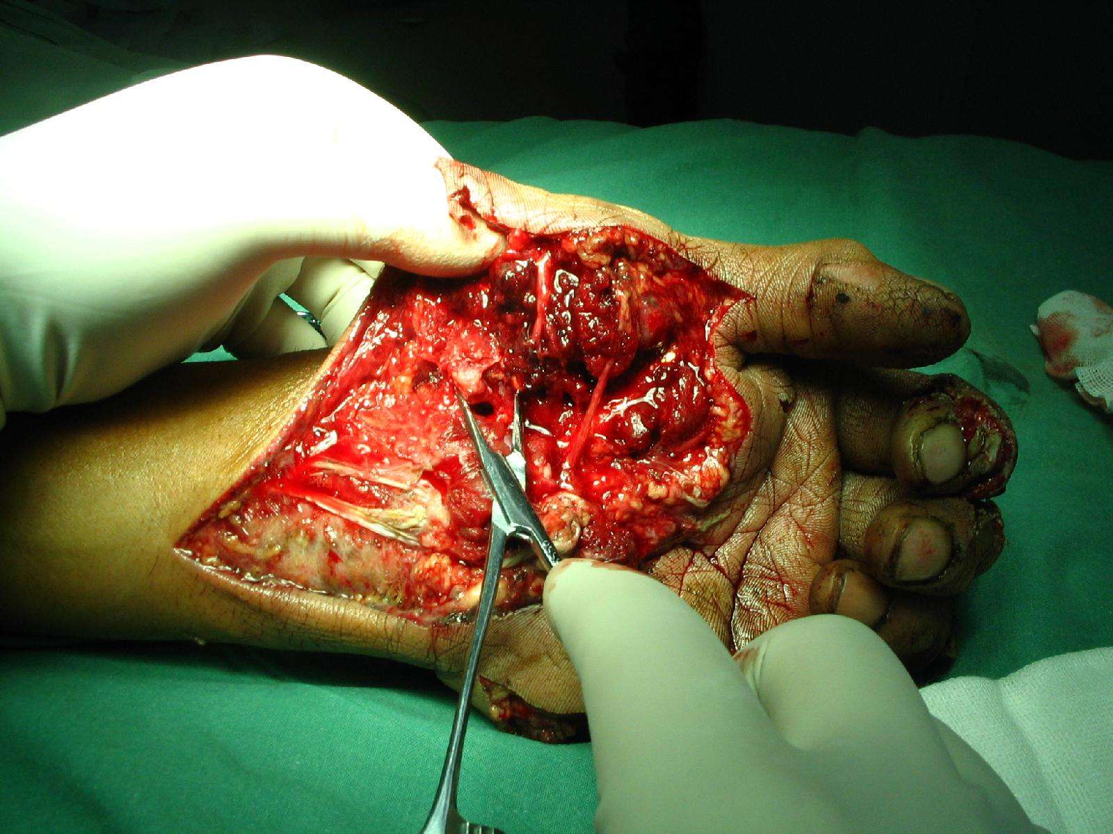 (图片)手部多发开放性损伤合并大多角骨脱位治疗 - 好大夫在线