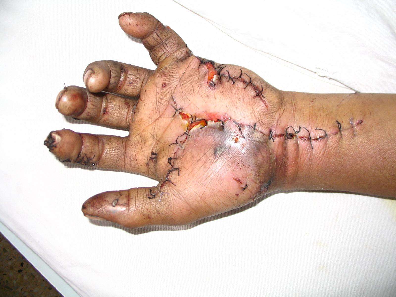 (图片)手部多发开放性损伤合并大多角骨脱位治疗 - 好大夫在线