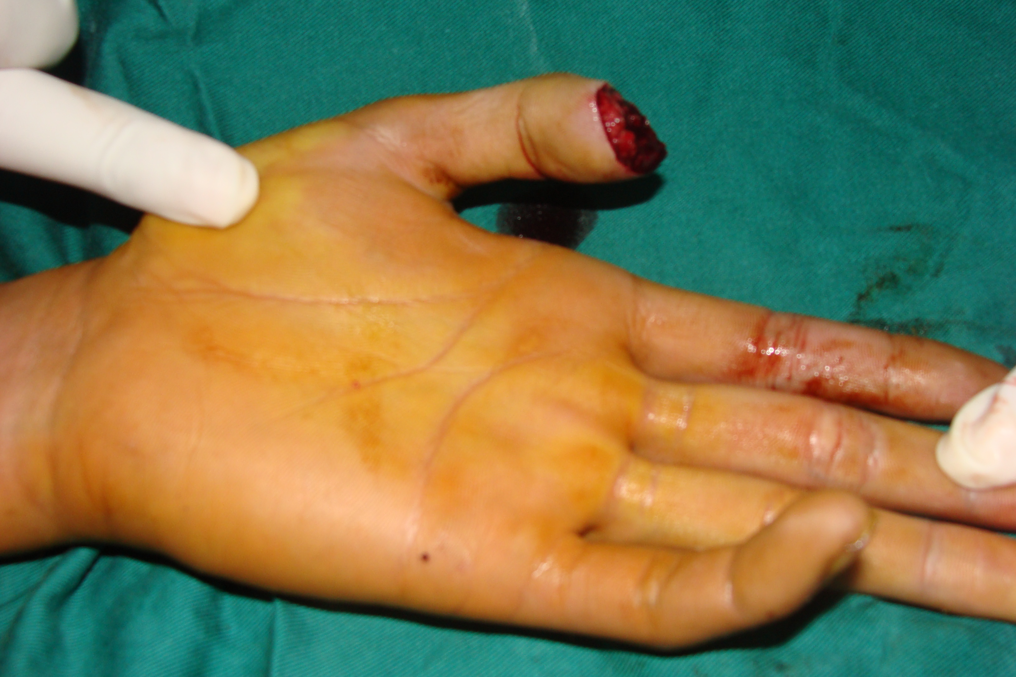 手指再造 - 好大夫在线