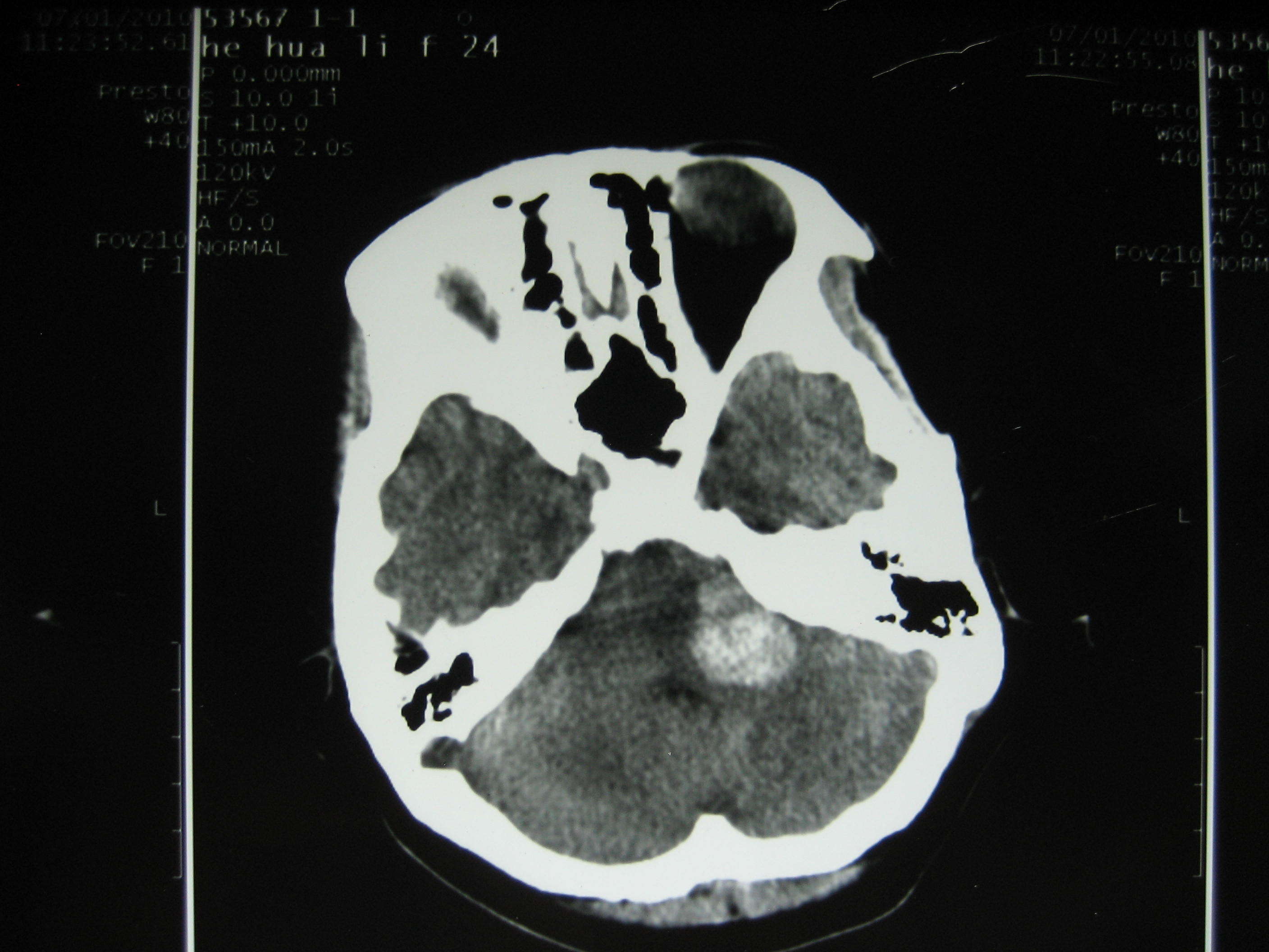 近期我做的典型手术病例4(脑干海绵状血管瘤) - 好大夫在线