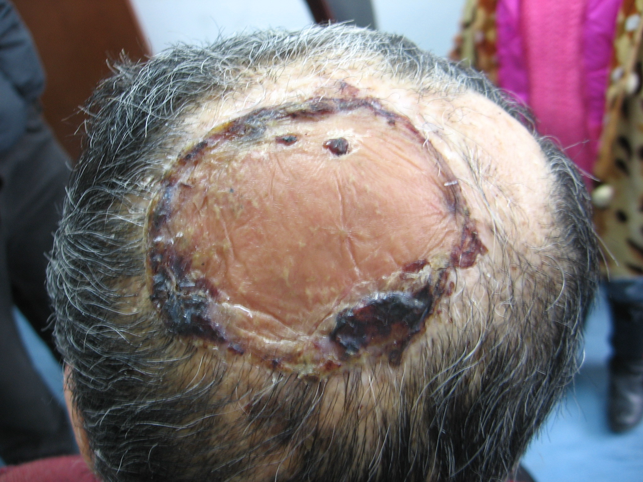 头部皮肤癌图片