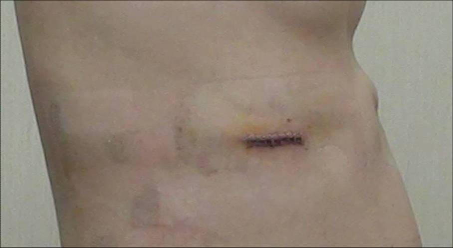 伤口长度2cm,在侧胸壁,正面看不到的.微创手术术前,双侧肋缘外翻.