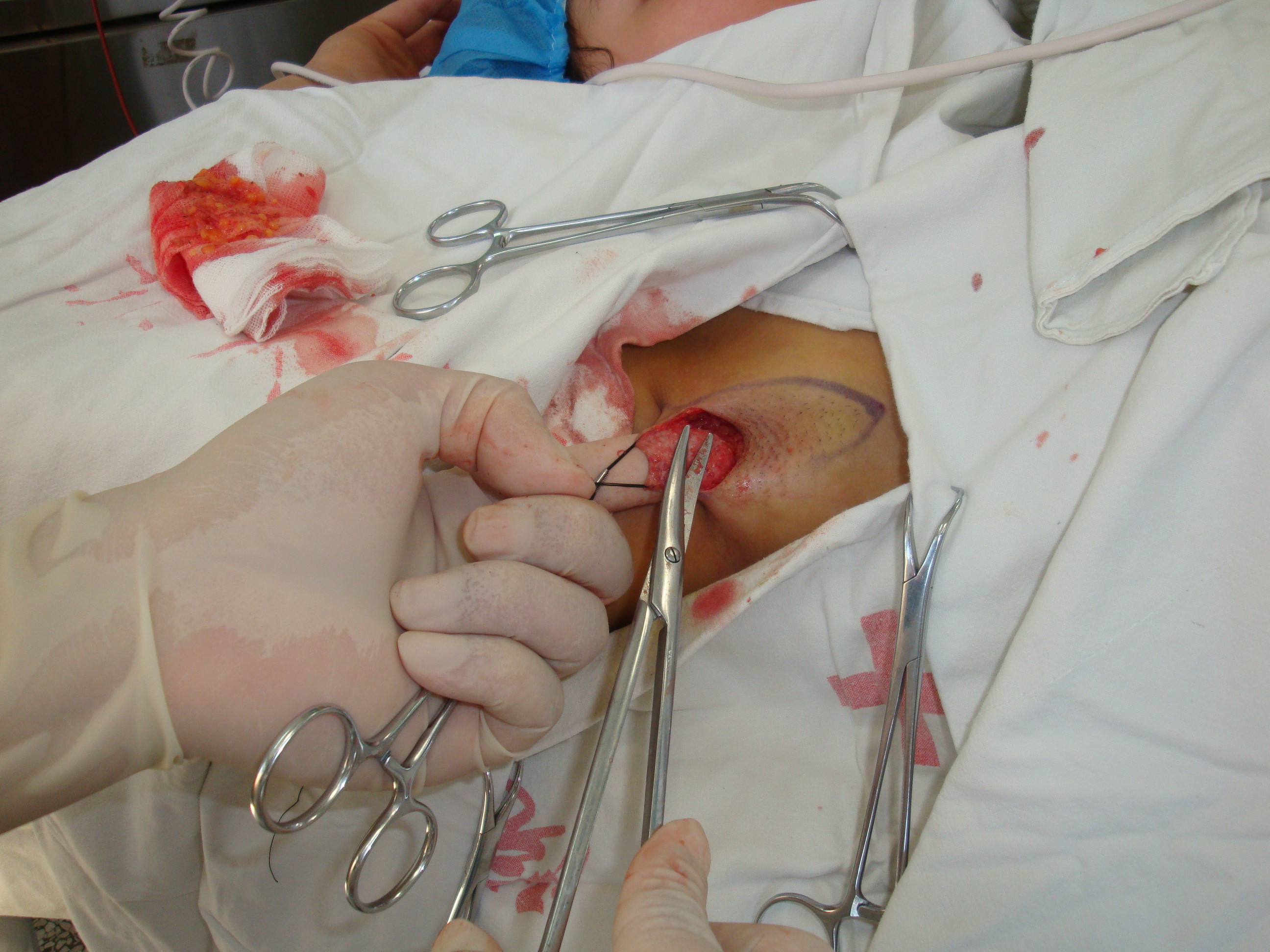 腋嗅根治术照片(微创技术) - 好大夫在线