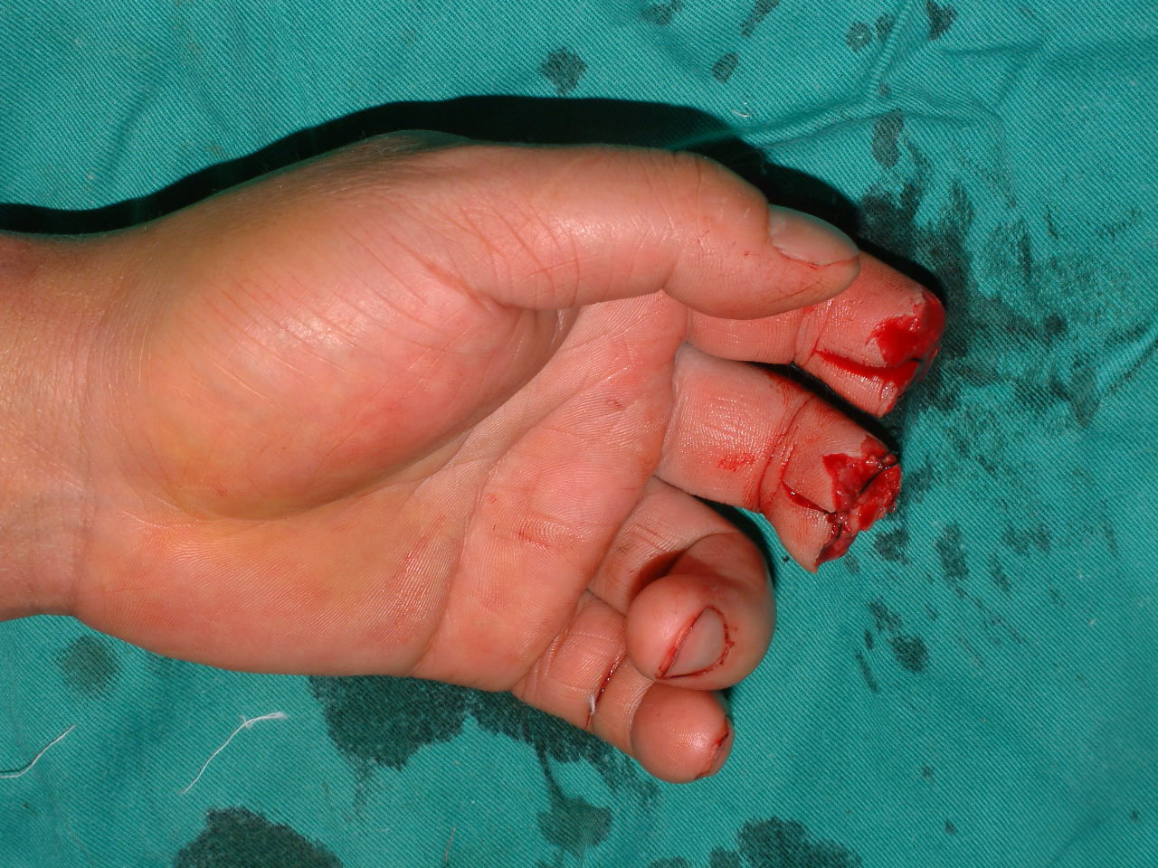 手指再造 - 好大夫在线