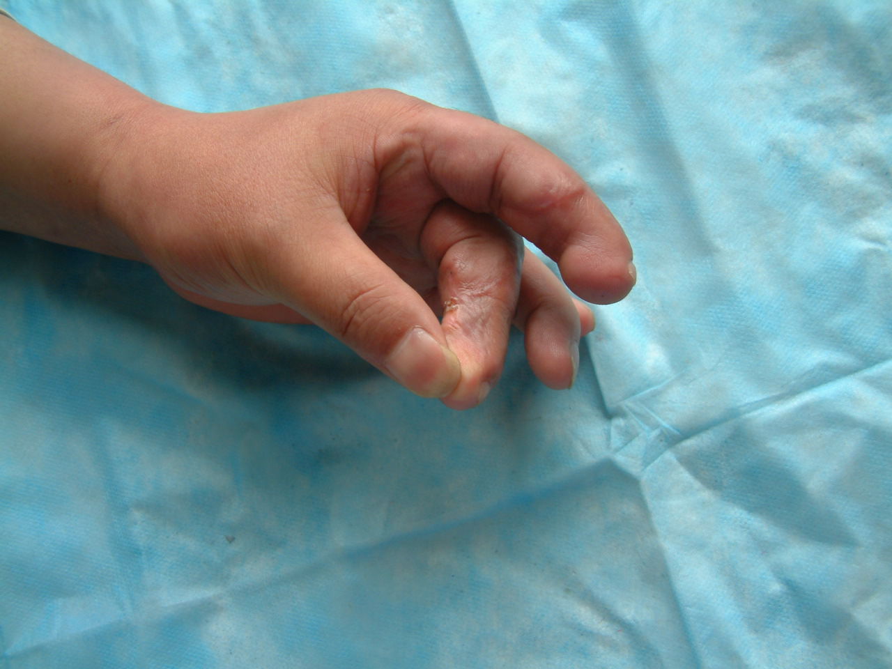 手指再造 - 好大夫在线