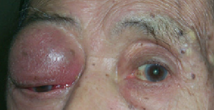 眼眶巨大肿瘤手术前后对比照片(二) - 好大夫在线