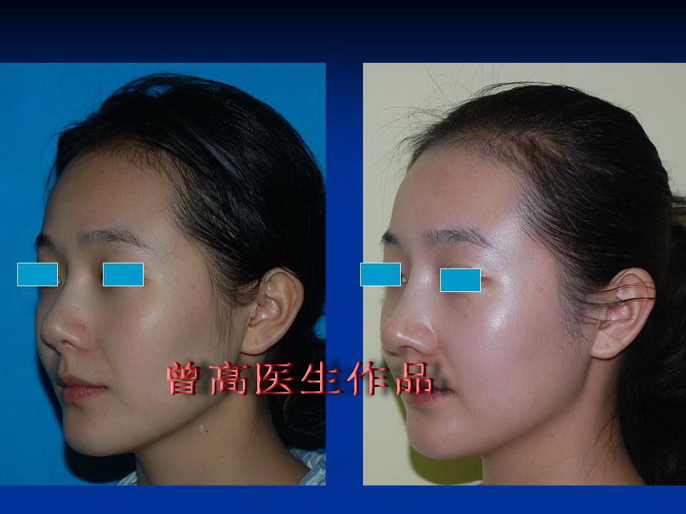 延长鼻尖鼻头缩小术前术后照片