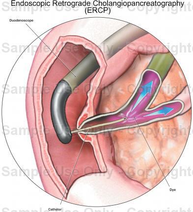ercp如何胆管取石?(图解说明) - 好大夫在线