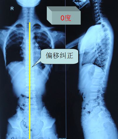 支具治疗脊柱侧弯典型病例3 - 好大夫在线