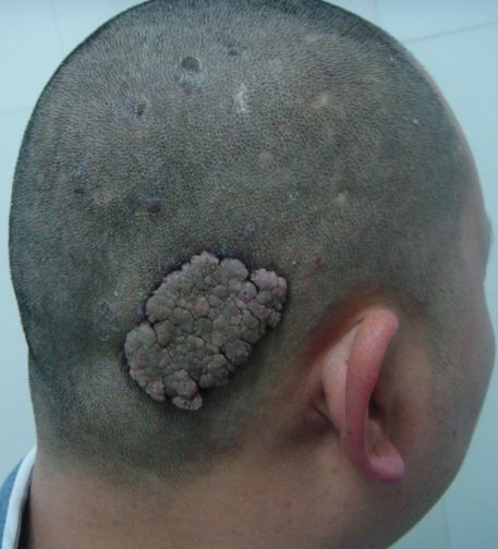头皮下纤维瘤图片