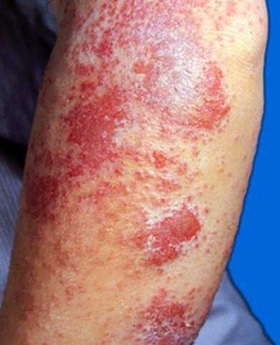 湿疹- 好大夫在线