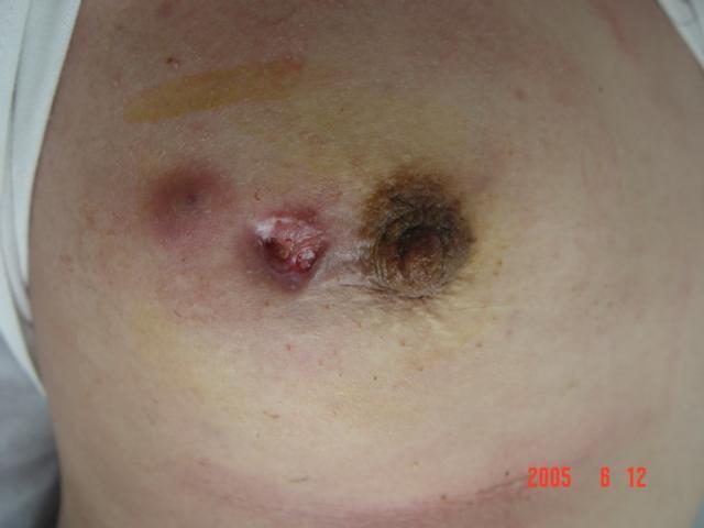 浆细胞乳腺炎 破溃图片