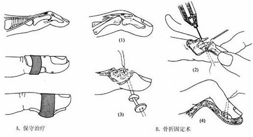 针对锤状指的手术治疗,我们采用微型骨锚钉重建肌腱止点 克氏针固定远