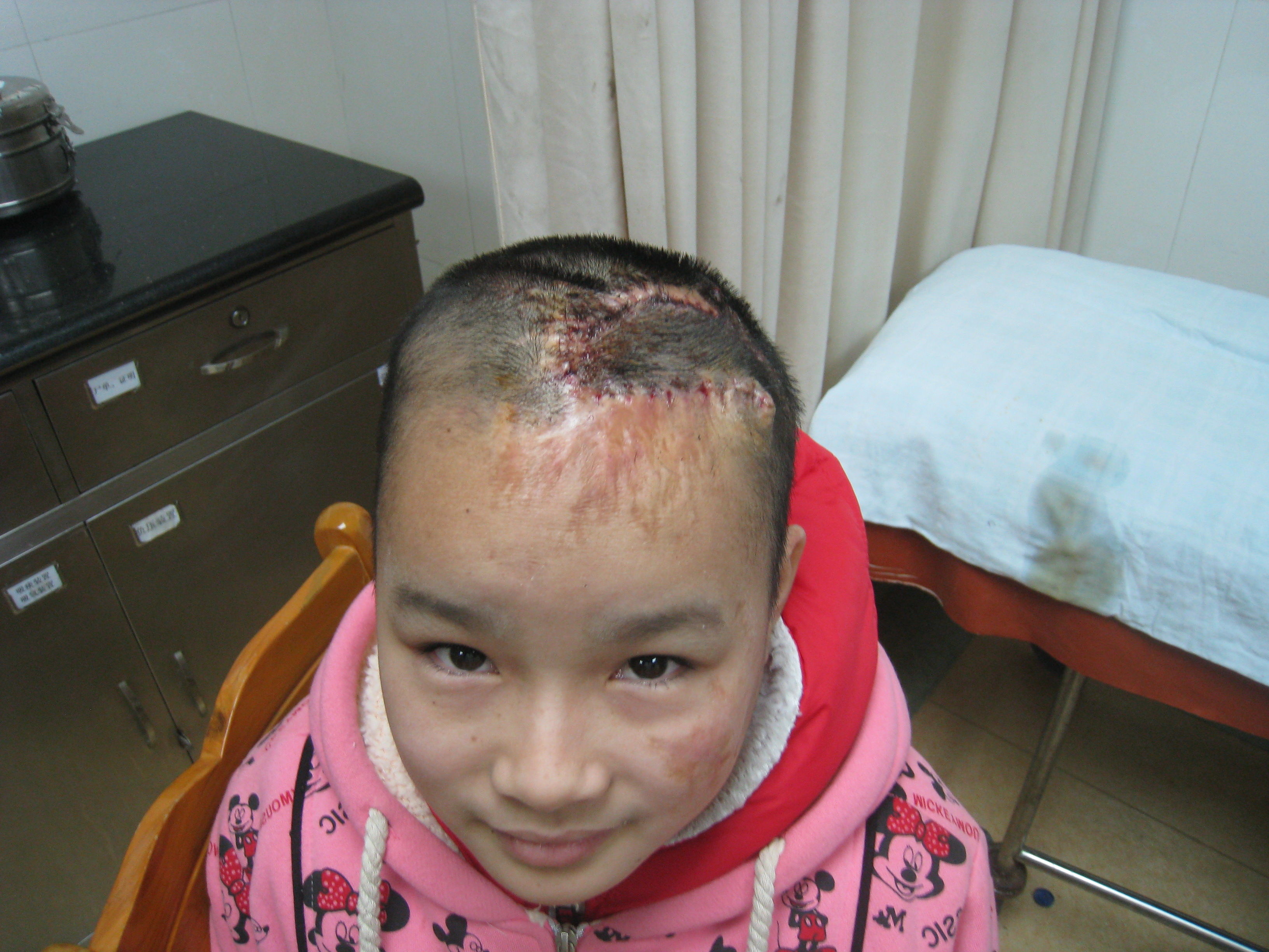 疤痕性秃发的(皮肤扩张器)治疗 - 好大夫在线