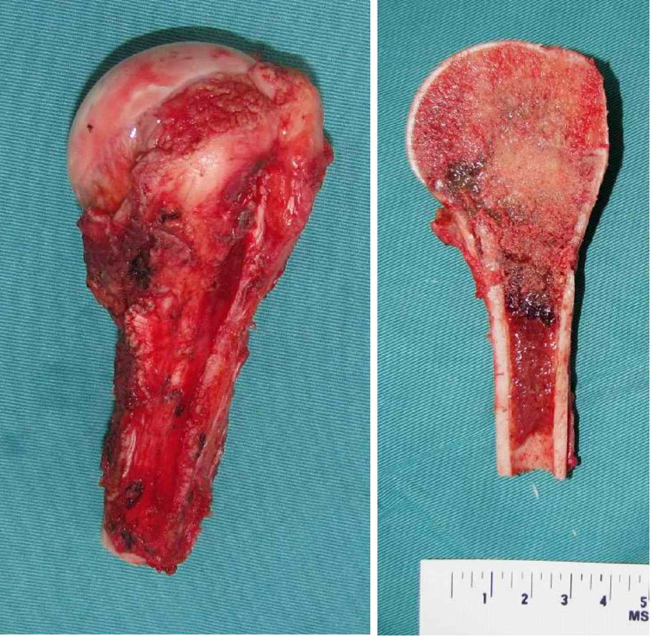 肱骨近端骨肉瘤的保肢治疗 - 好大夫在线