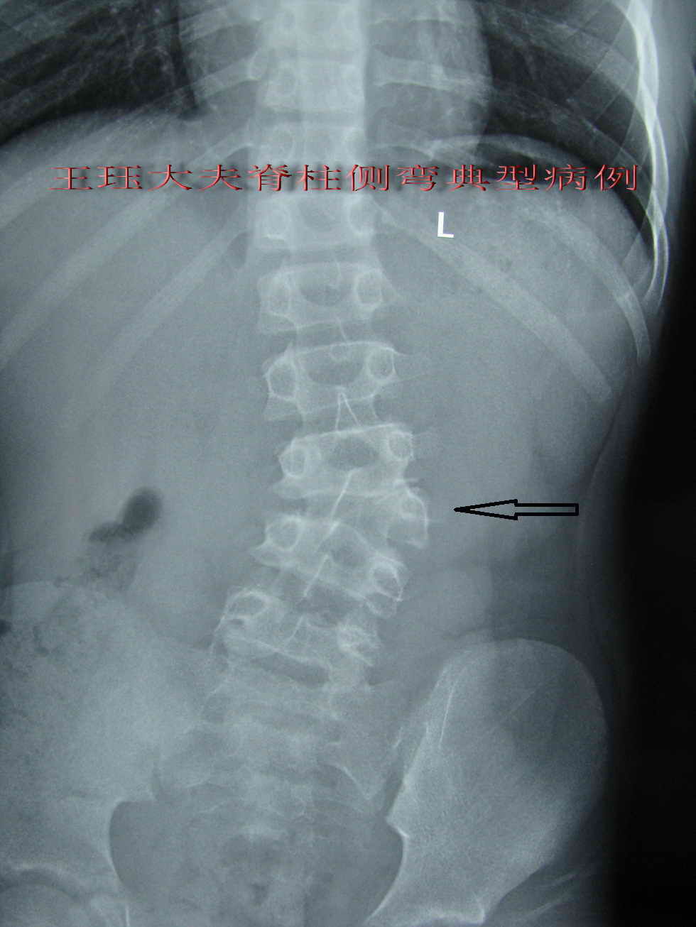 患者:男,11岁,先天性脊柱侧弯