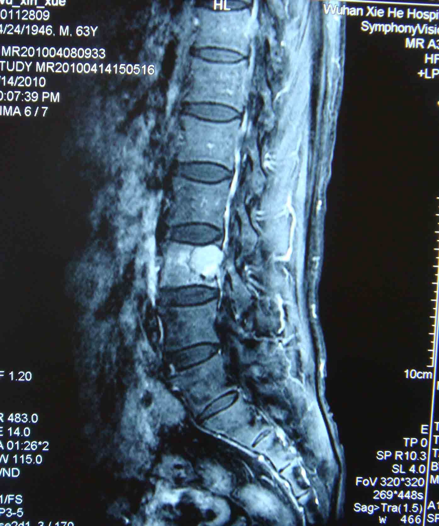 术后x线片采用前后联合入路行全脊椎整块切除,术中先从后路切除腰4
