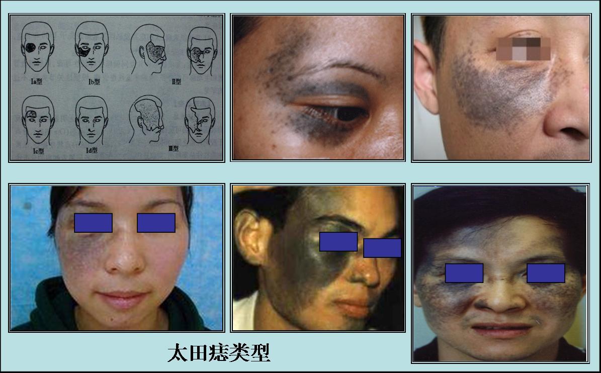 真皮色素增生:太田痣,颧部褐青色痣,文身. - 好大夫在线