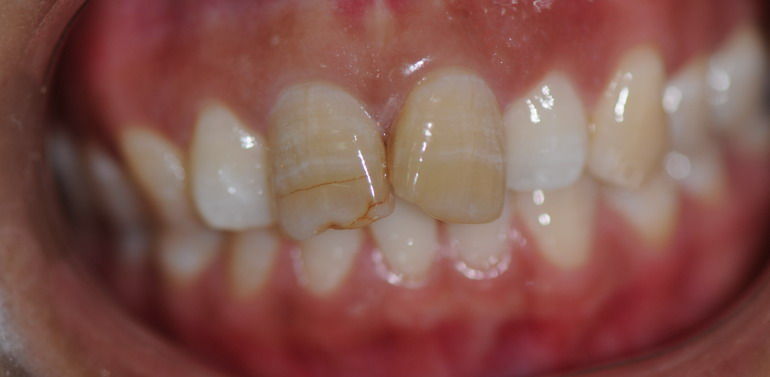 磨牙裂纹图片