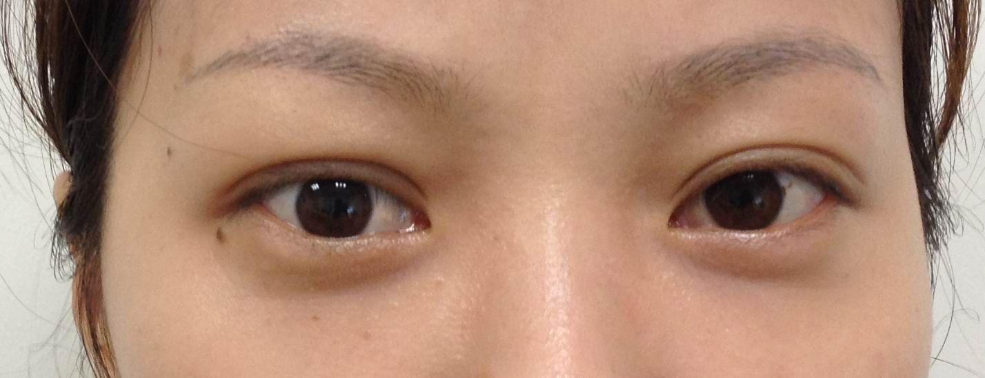 上睑退缩术前术后对比图 - 好大夫在线