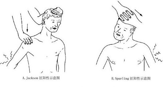 神经根型颈椎病的病因病理
