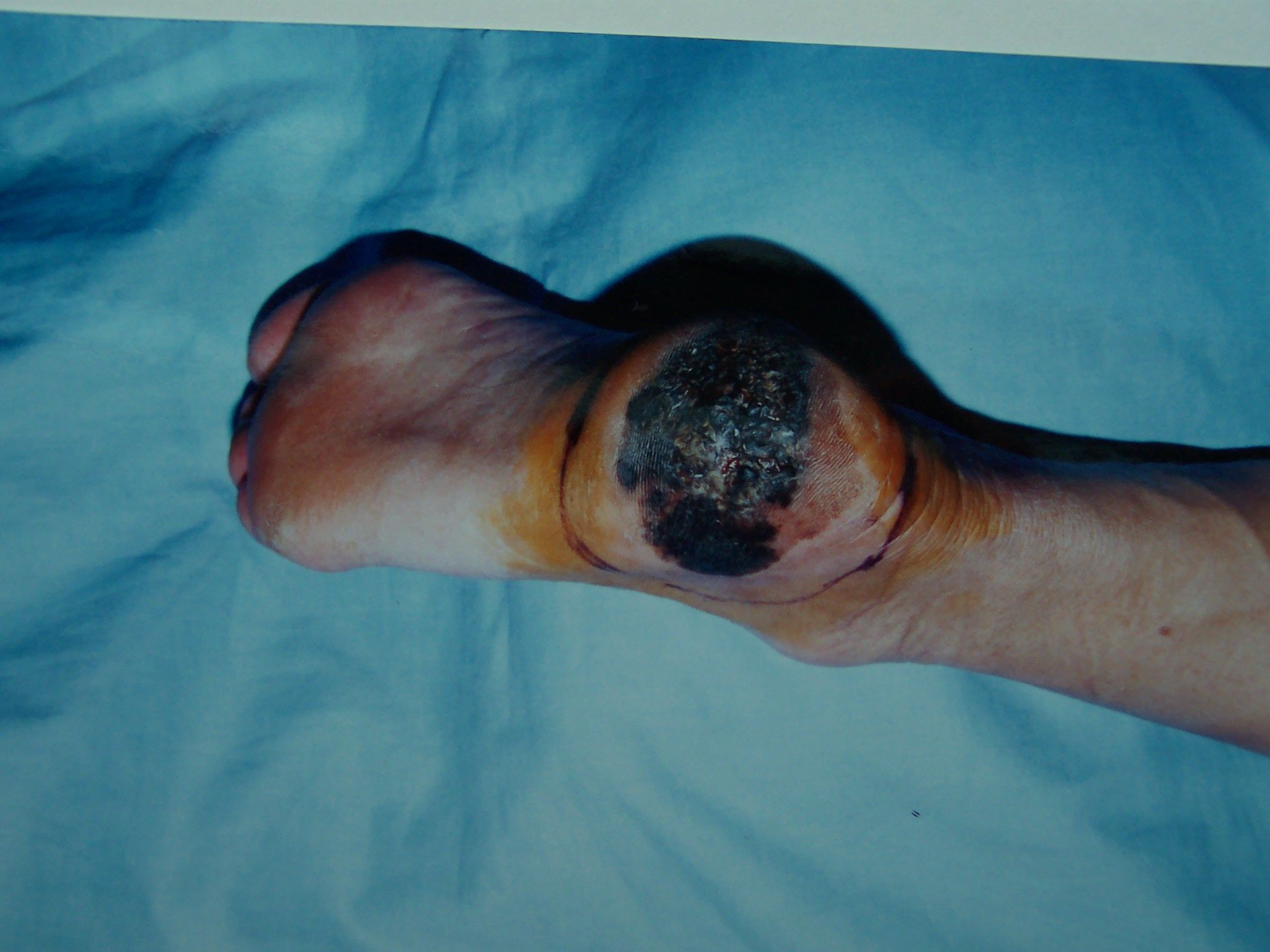 恶性黑色素瘤晚期症状图片