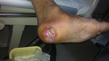 糖尿病足患者下肢动脉闭塞的治疗 - 好大夫在线