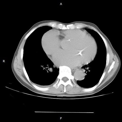 术前胸部ct:心脏明显增大.