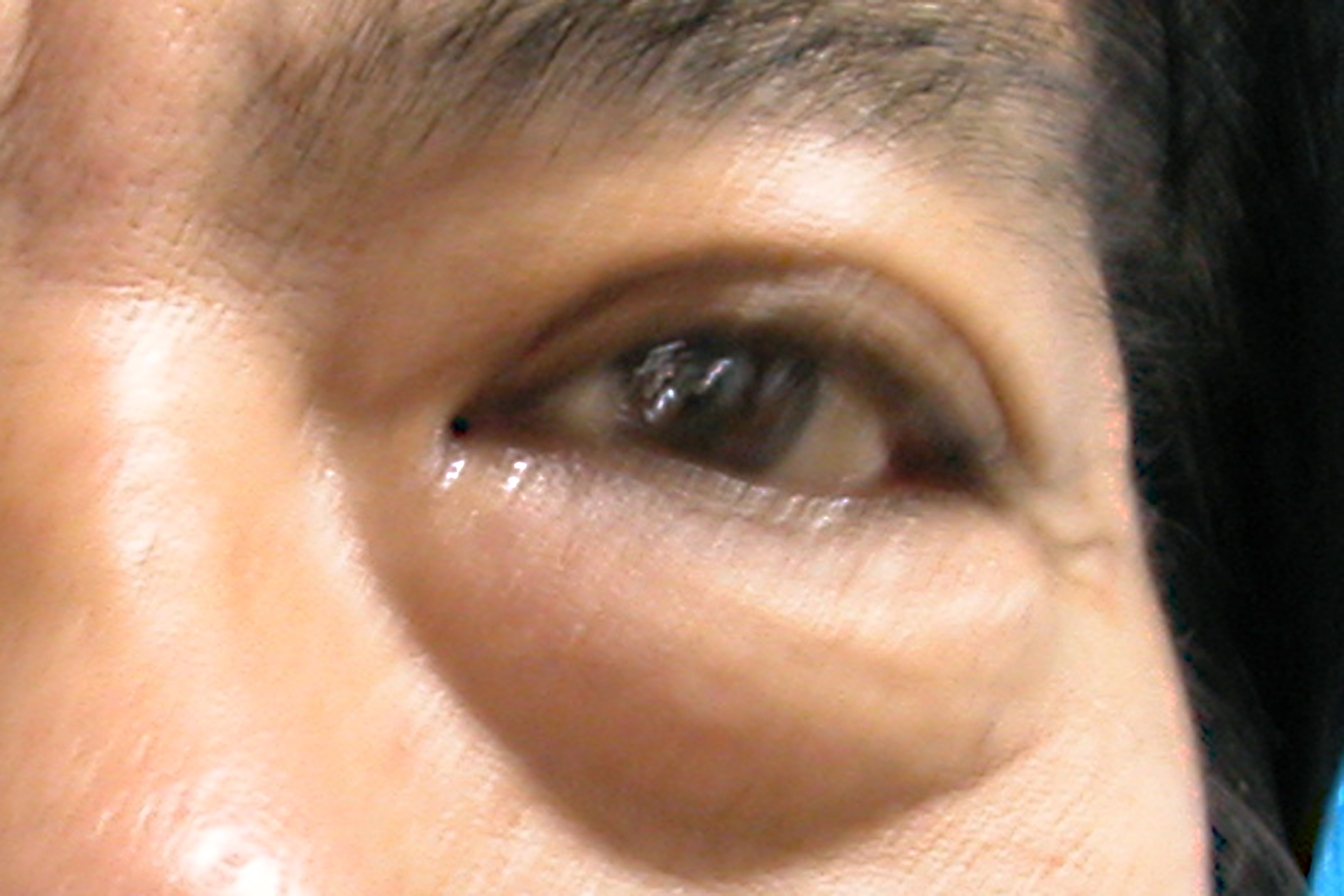 下眼袋(术前和拆线后1周) - 好大夫在线