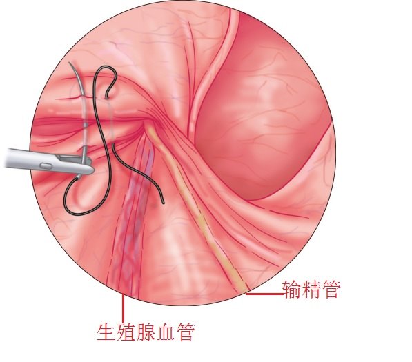 附图:腹腔镜疝修补手术图