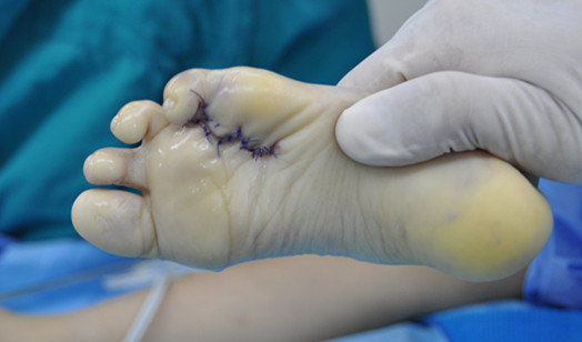 双足先天性畸形整形 - 好大夫在线