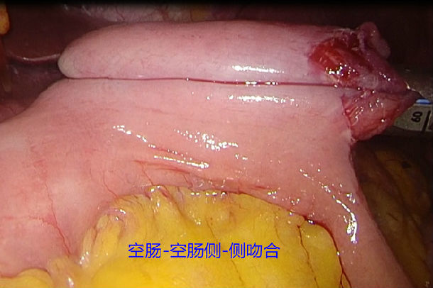 完全腹腔镜下近端胃大部切除术(双通道消化道重建) - 好大夫在线