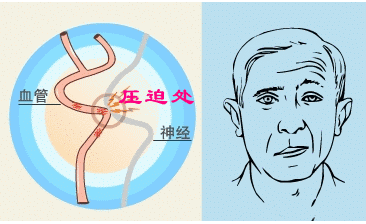 面肌痉挛一定要手术吗?