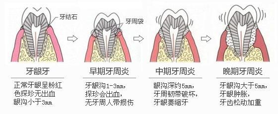 牙周炎的引发的四大诱因