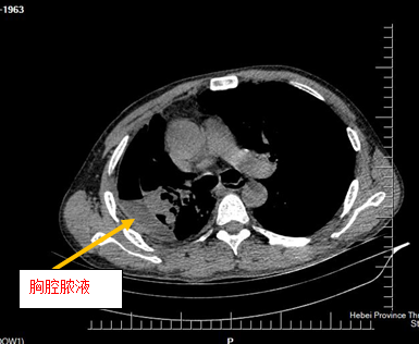 结核性支气管胸膜瘘——困扰患者多年的顽疾终于被治好了 - 好大夫
