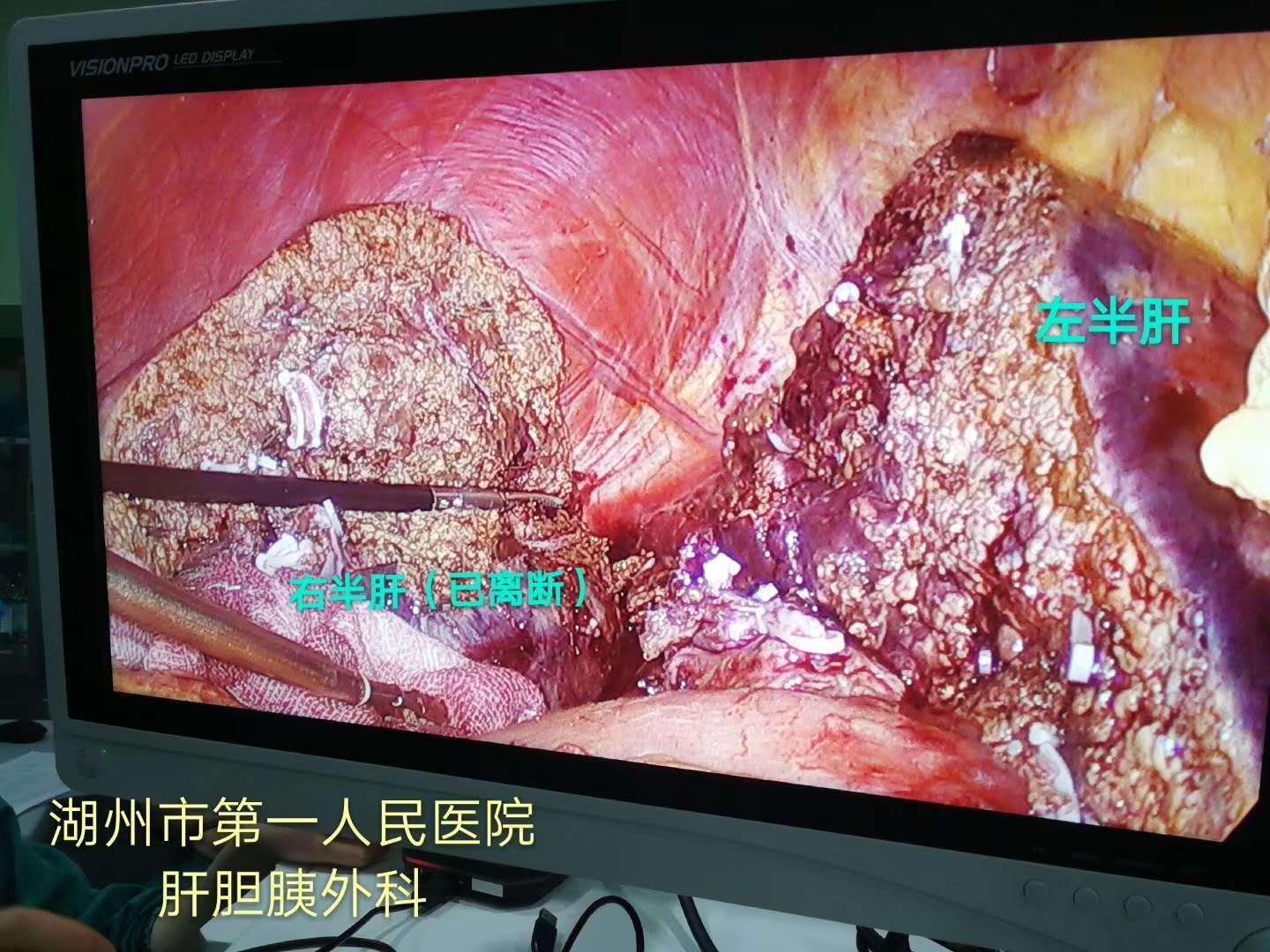 【腹腔镜右半肝切除术】 - 好大夫在线